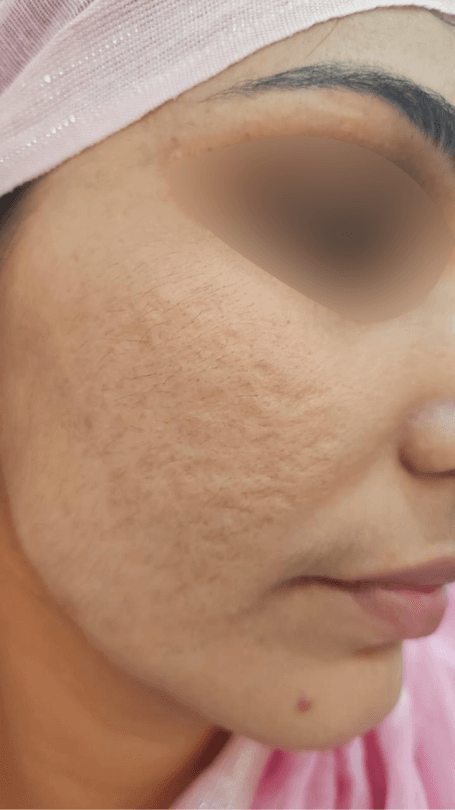 Acne Scar Treatment after