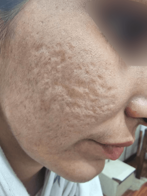Acne Scar Treatment before