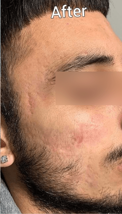 Acne Scar Treatment - After