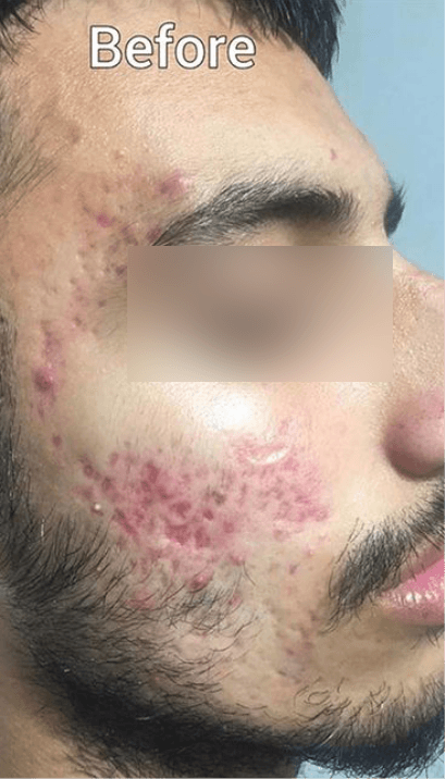 Acne Scar Treatment - Before