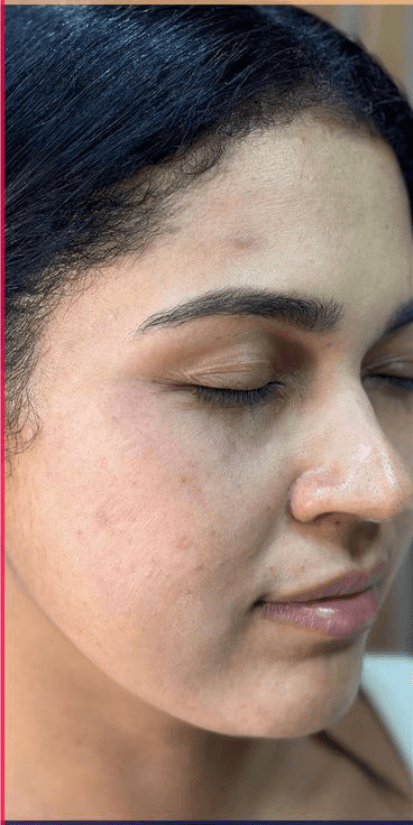 Acne Scar Treatment - After