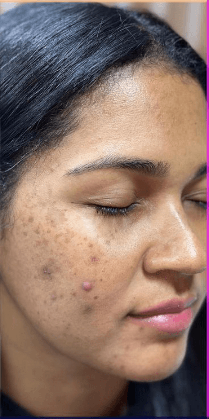Acne Scar Treatment - Before