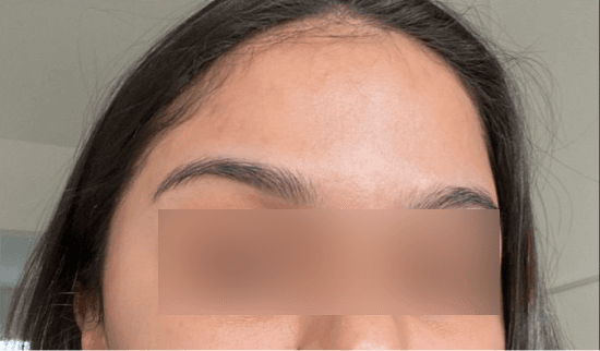 Acne Scar Treatment - After