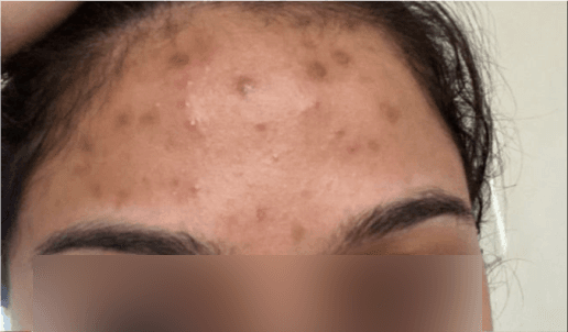 Acne Scar Treatment - Before