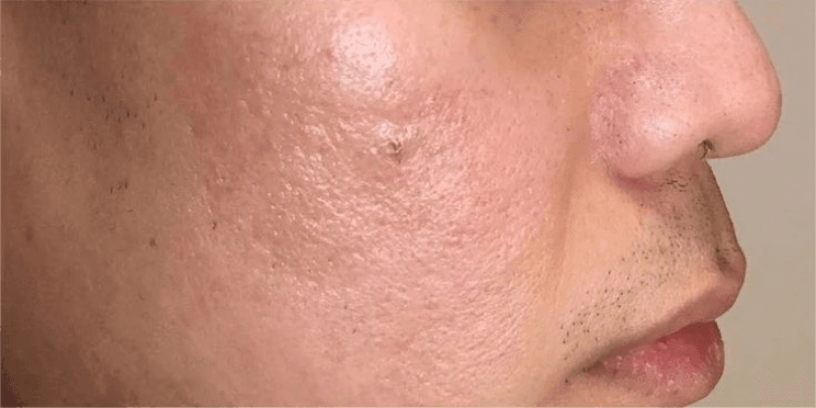 Acne Scar Treatment - After