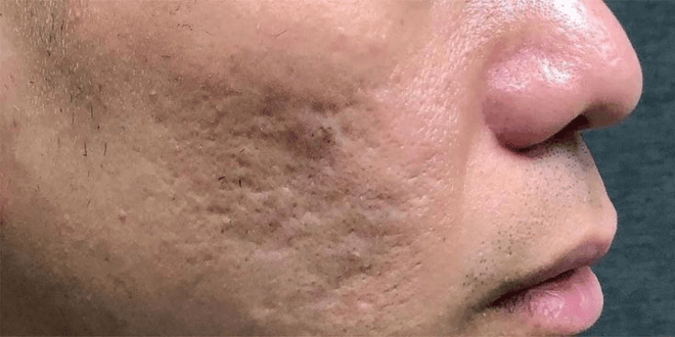 Acne Scar Treatment - Before