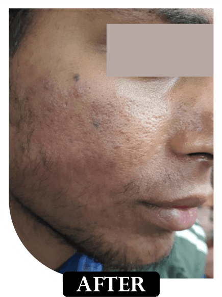 Acne Scar Treatment - After