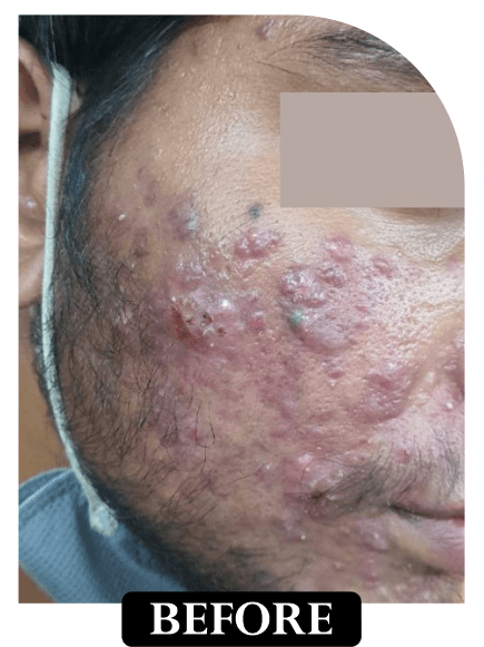 Acne Scar Treatment - Before