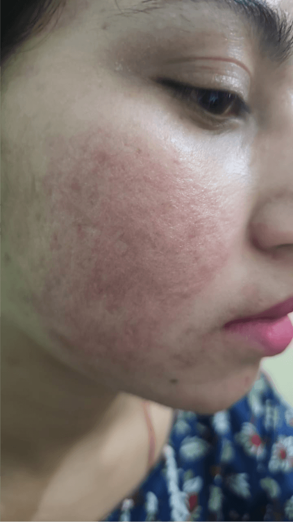 Acne Scar Treatment - After
