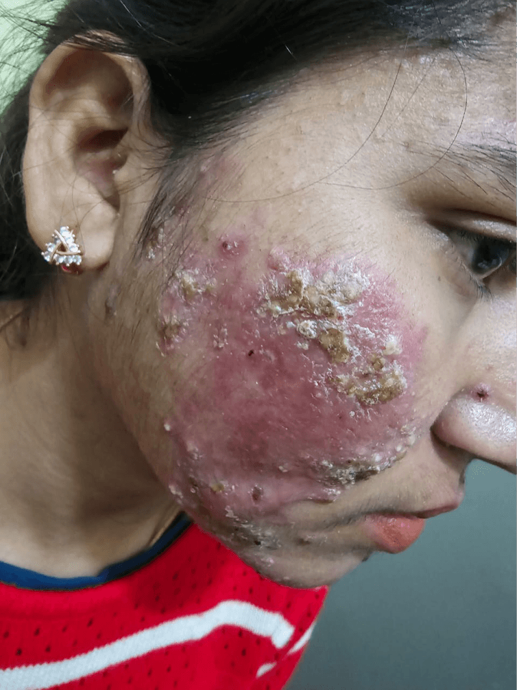 Acne Scar Treatment - Before