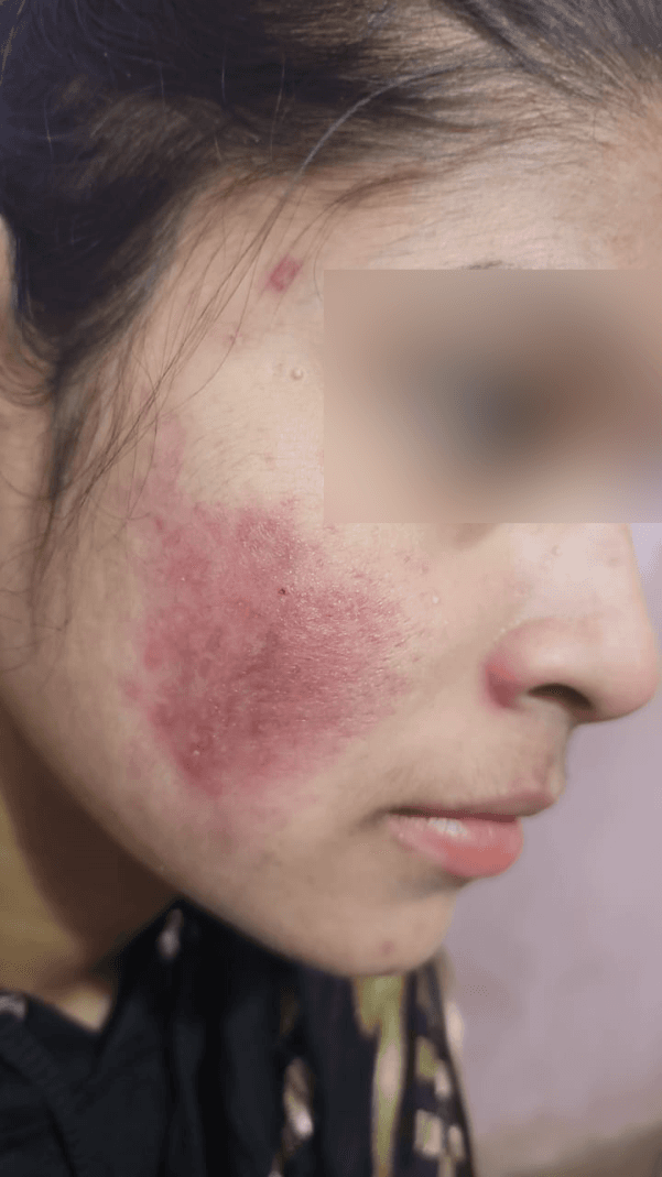 Acne Scar Treatment - After