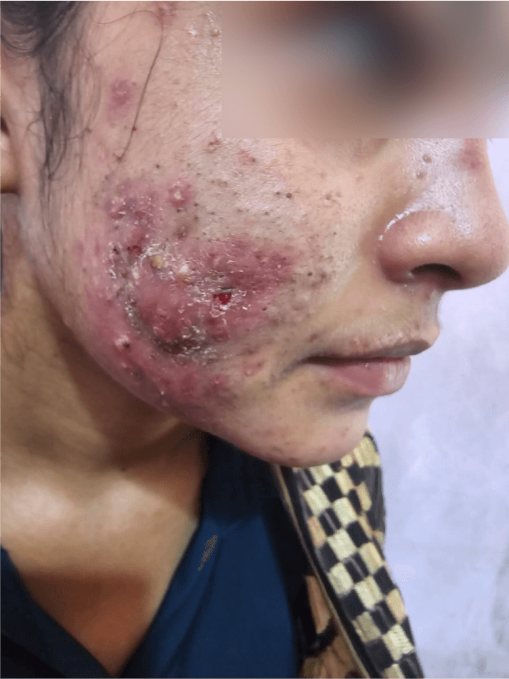 Acne Scar Treatment - Before