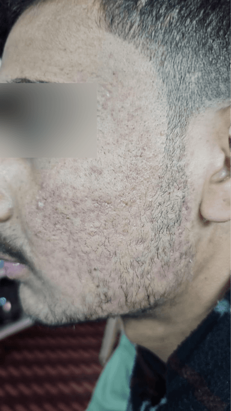 Acne Scar Treatment - After
