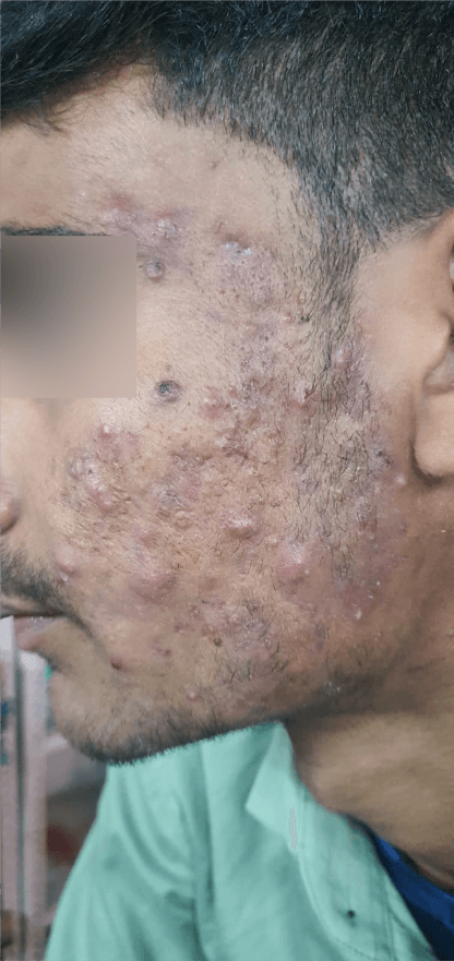 Acne Scar Treatment - Before