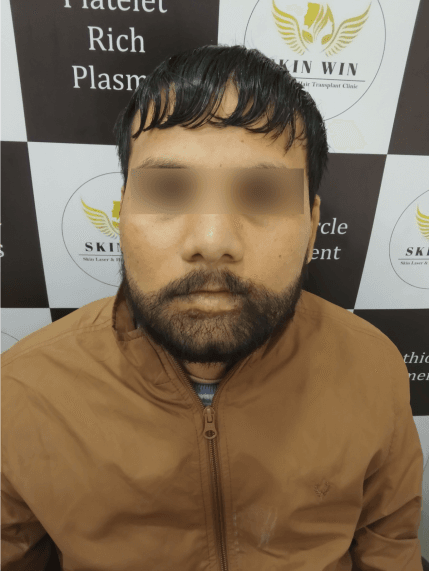 Beard Transplant - After