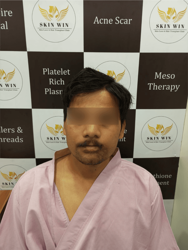 Beard Transplant - Before