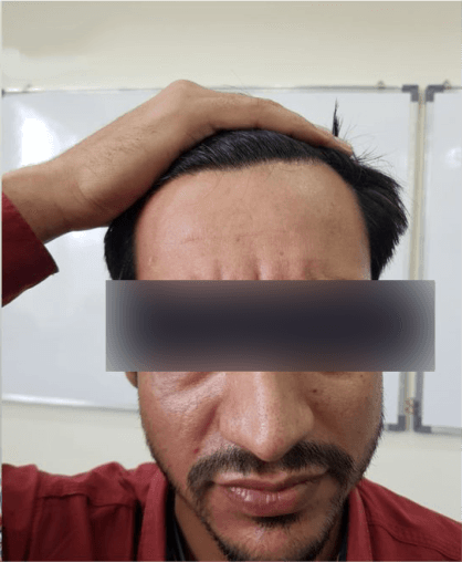 Botox Anti-Aging - After