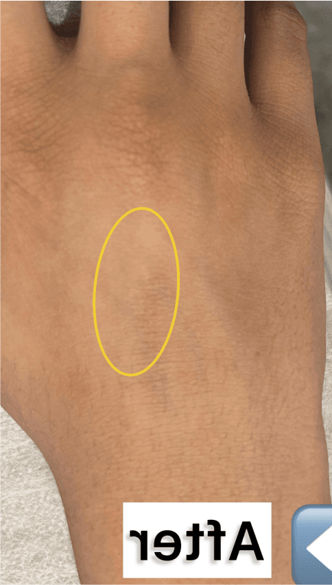 Burn Scar Treatment - After