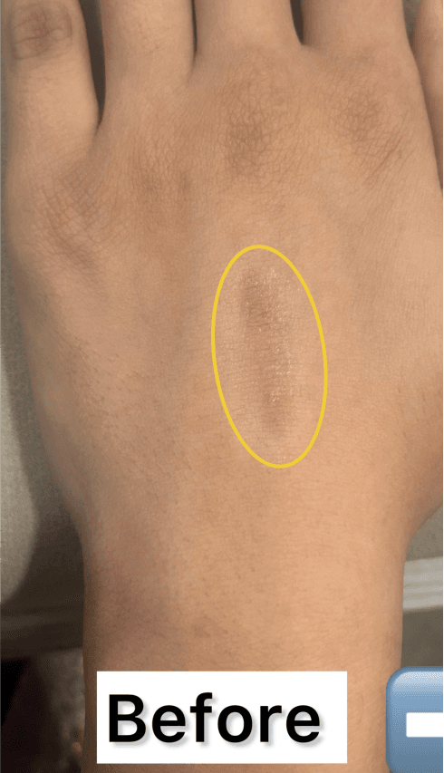 Burn & Surgical Scars