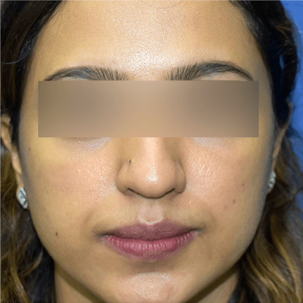 Carbon Facial Treatment - After