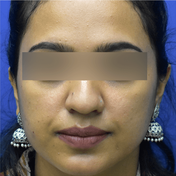 Carbon Facial Treatment - Before
