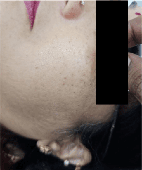Freckles Removal - After