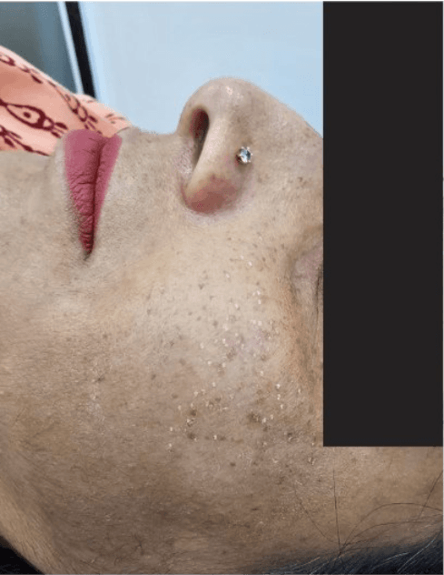 Freckles & Sun Damage