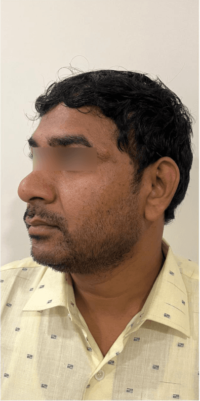 HIFU Non-Surgical Lift - After