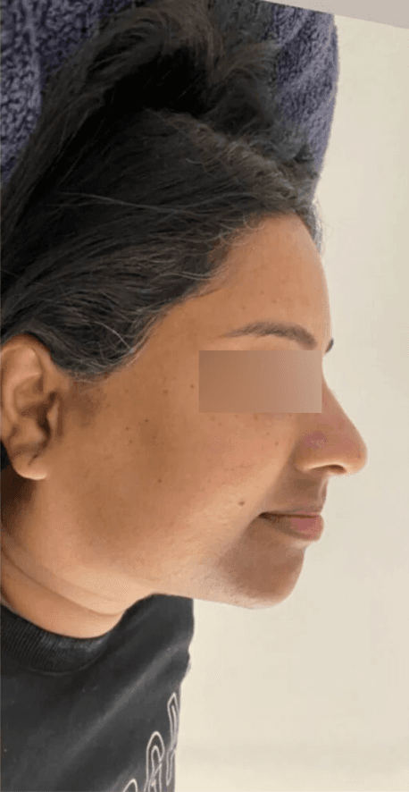 HIFU Non-Surgical Lift - After
