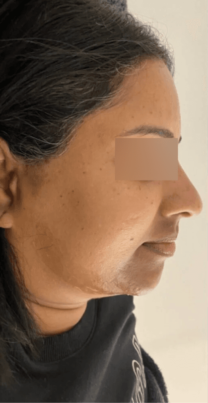 HIFU Non-Surgical Lift - Before