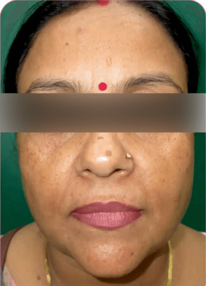 HIFU Non-Surgical Lift - After