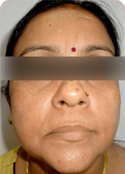 HIFU Non-Surgical Lift - Before