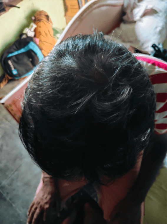 Hair Fall Treatment - After