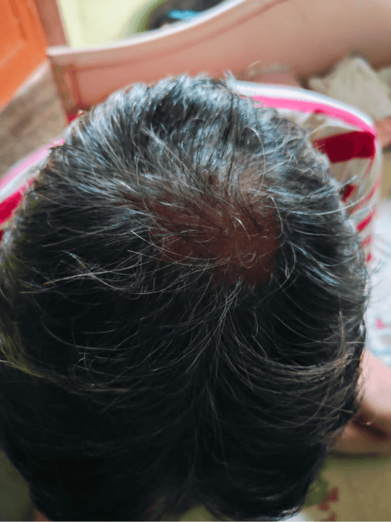 Hair Loss & Thinning