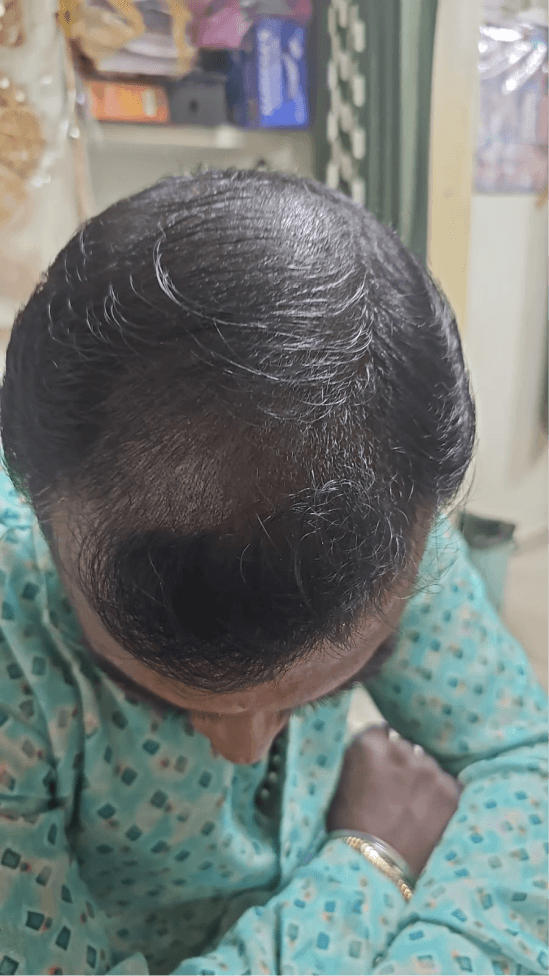 Hair Fall Treatment - After