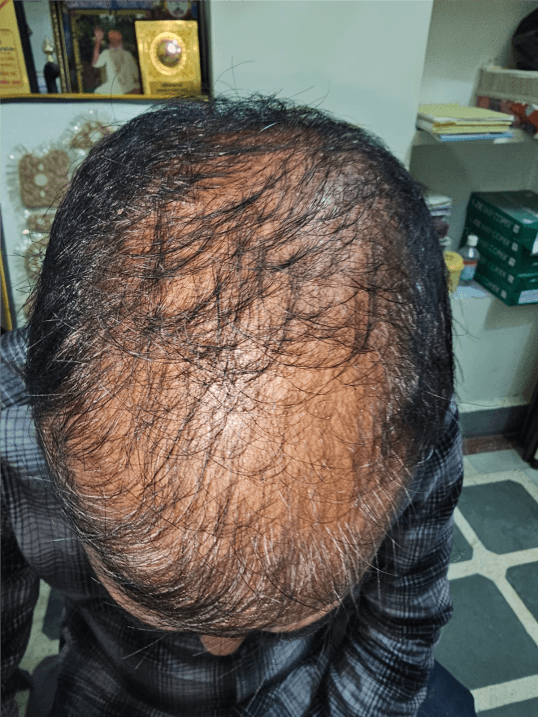 Hair Fall Treatment - Before