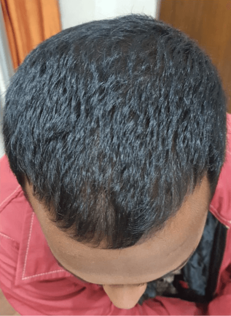 Hair Fall Treatment - After