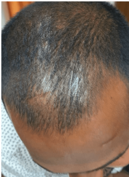 Hair Fall Treatment - Before