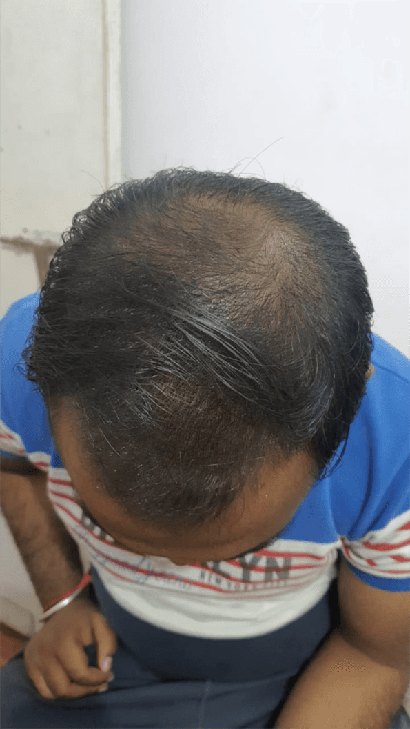 Hair Fall Treatment - After