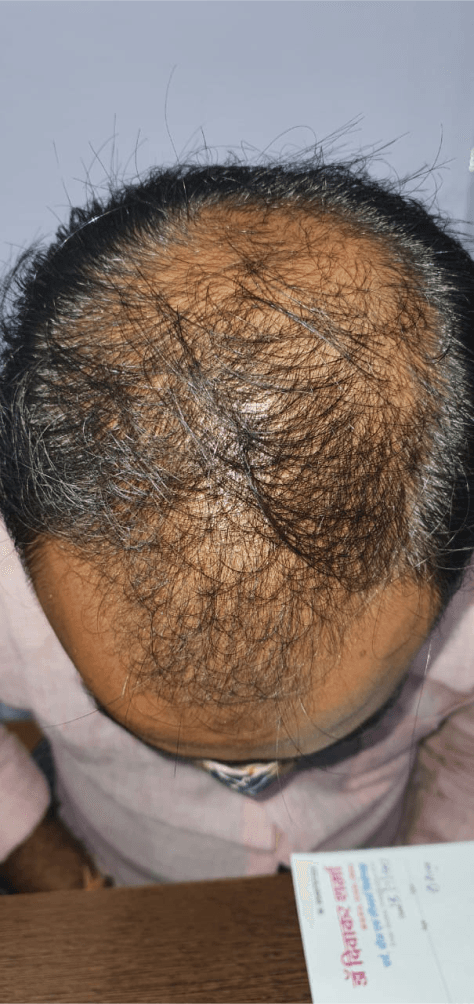 Hair Fall Treatment - Before