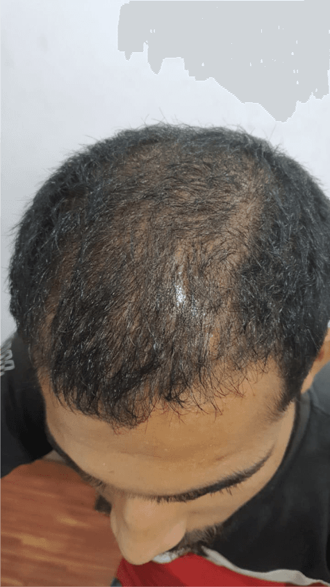 Hair Fall Treatment - After