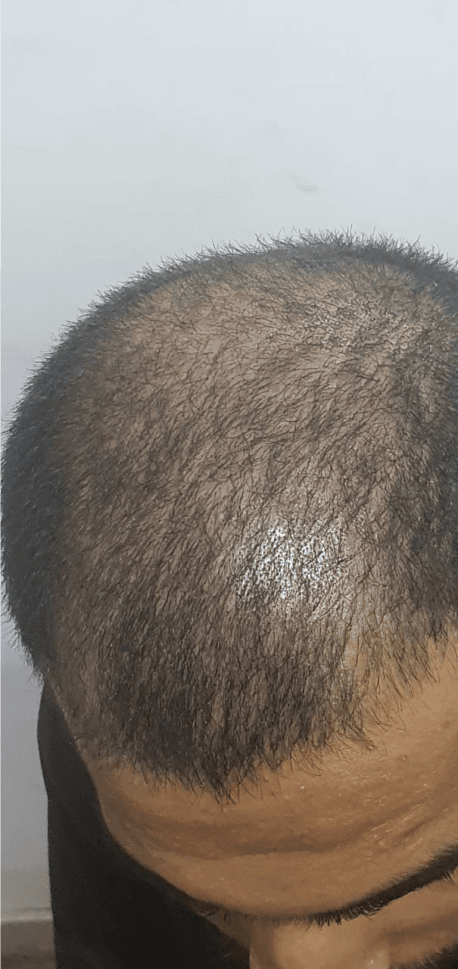 Hair Fall Treatment - Before