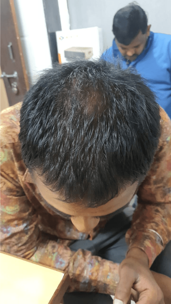 Hair Fall Treatment - After