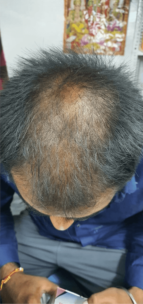 Hair Fall Treatment - Before