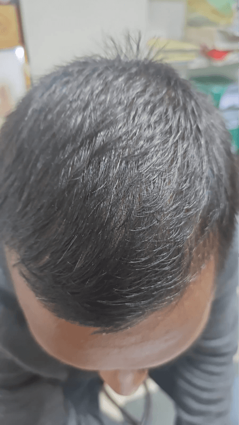 Hair Fall Treatment - After
