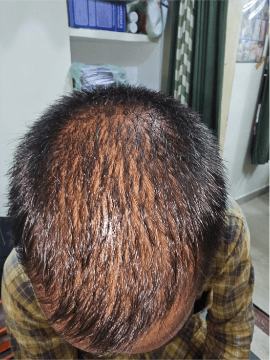 Hair Fall Treatment - Before