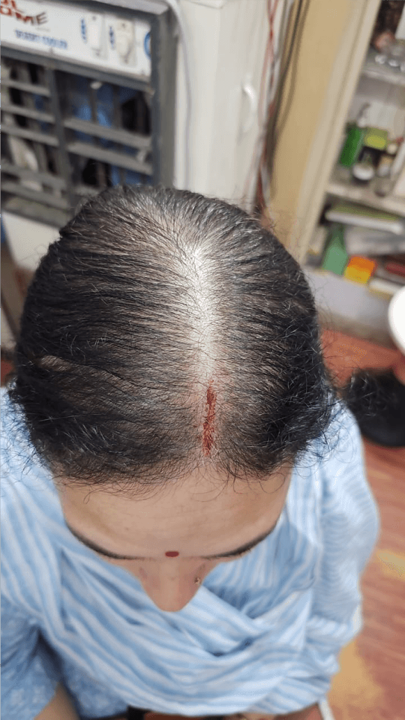 Hair Fall Treatment - After