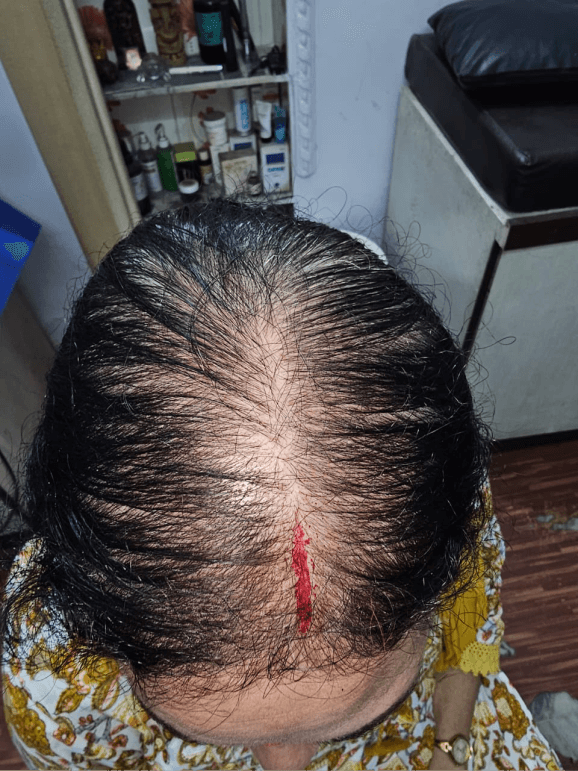 Hair Fall Treatment - Before