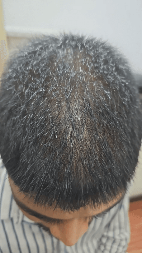 Hair Fall Treatment - After