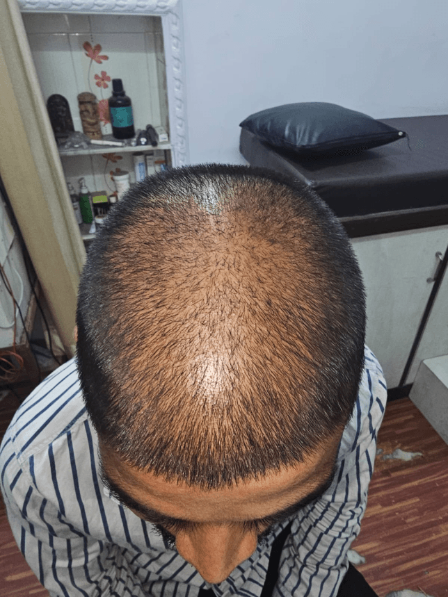 Hair Fall Treatment - Before